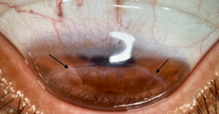 Custom scleral lenses for complex corneal and ocular surface conditions