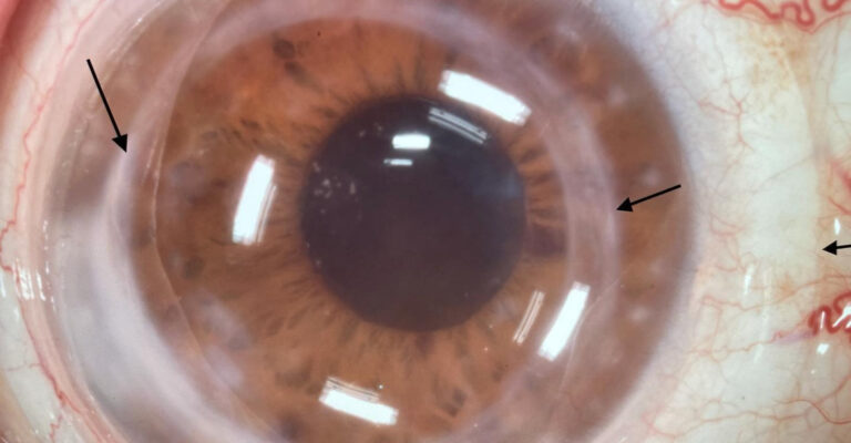 What Is A Scleral Lens