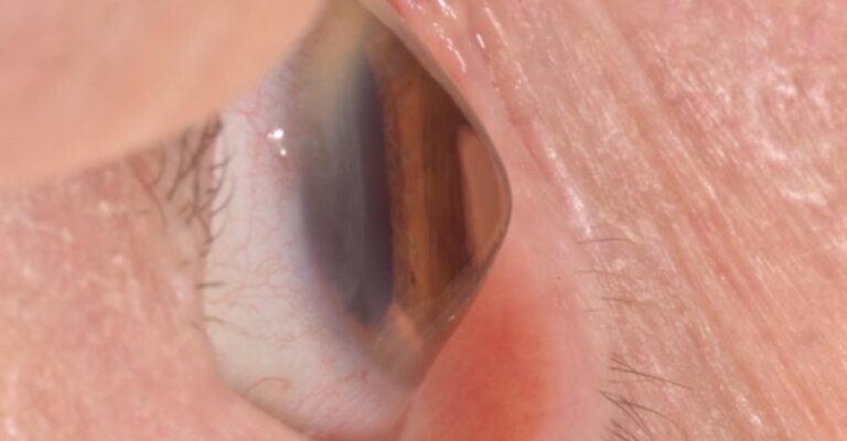 What Is The Best Scleral Lens