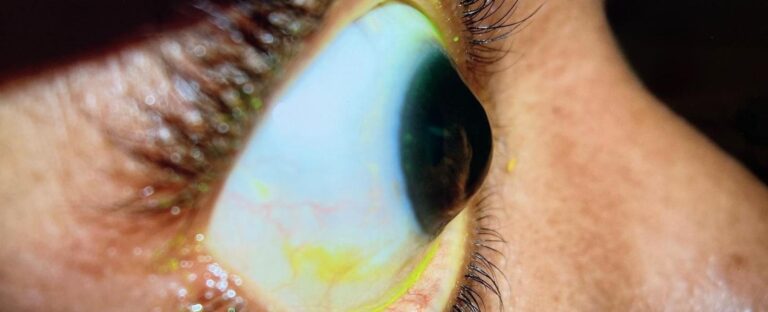 Keratoconus and irregular cornea evaluation
