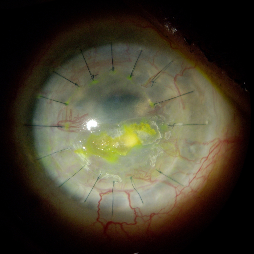 failed and rejected transplanted cornea
