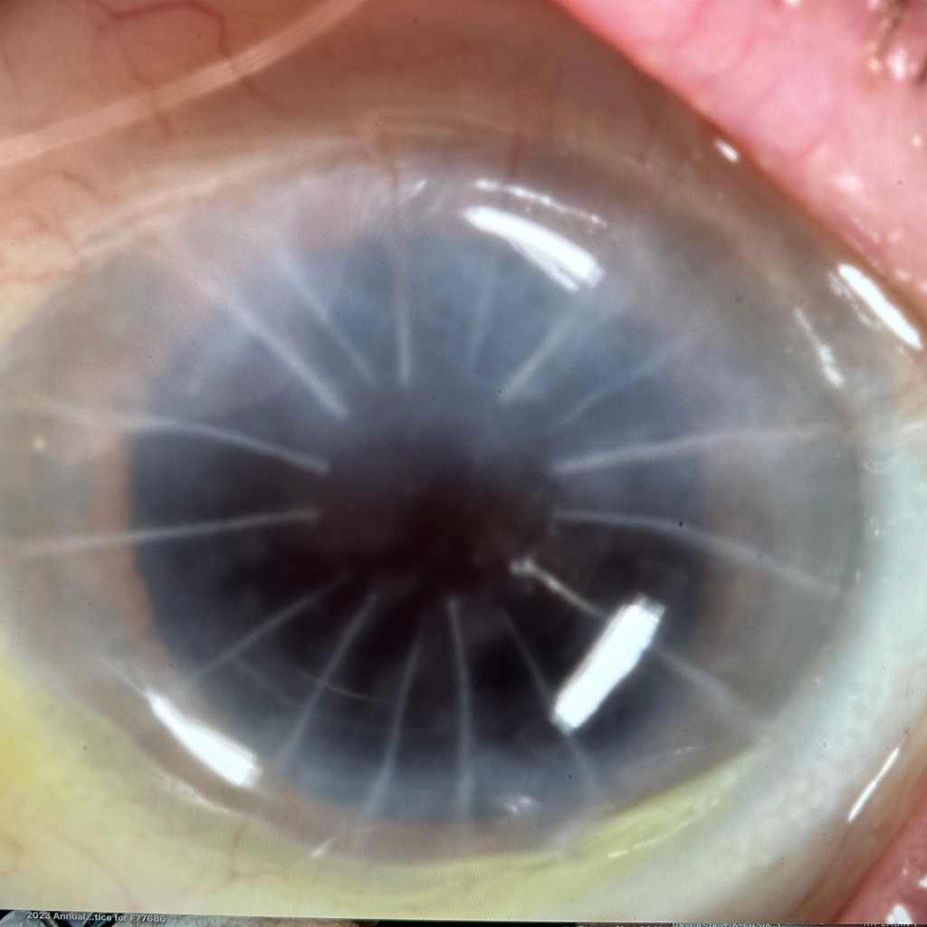 post surgical vision loss- After Radial Keratotomy surgery