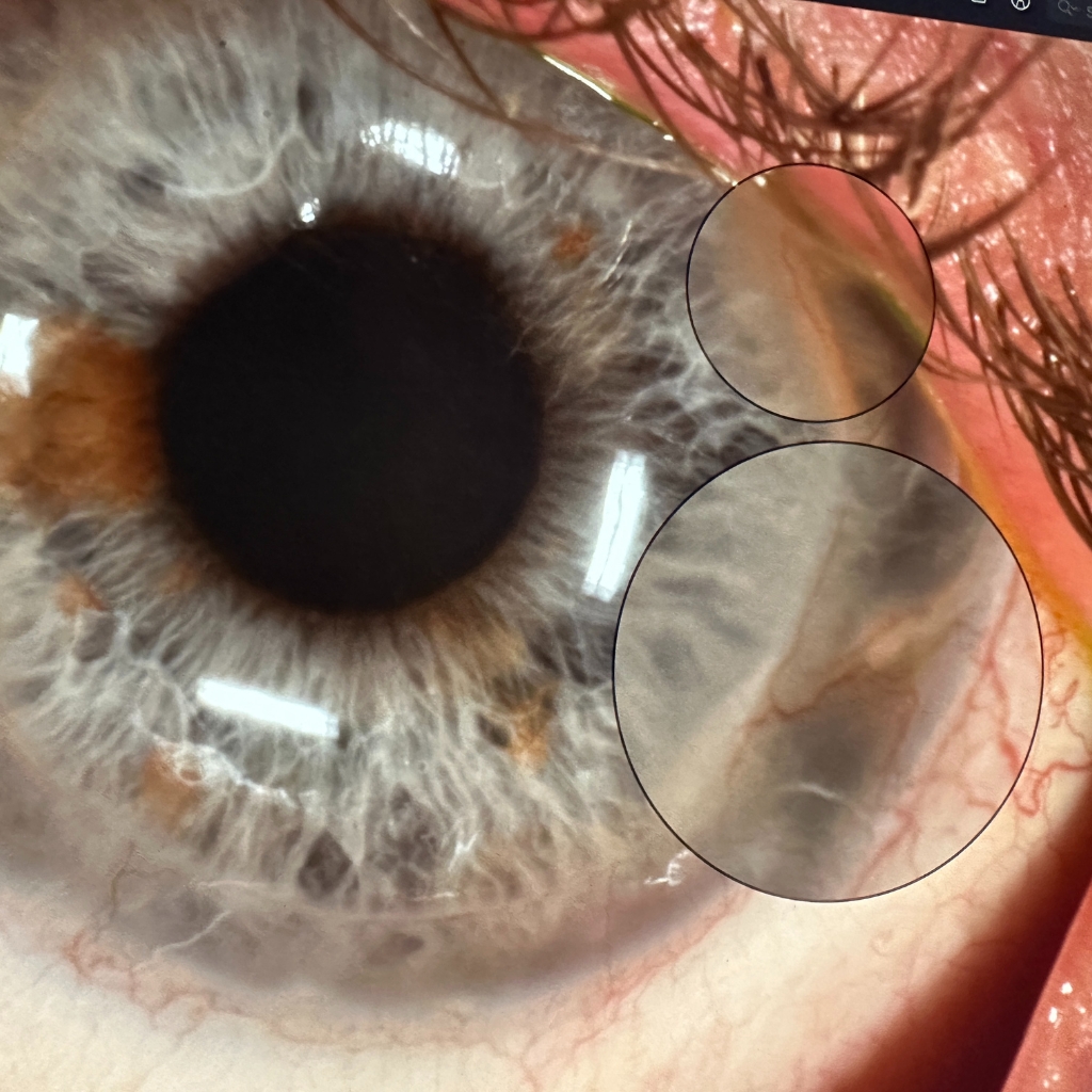 post surgical vision loss due to corneal transplant surgery