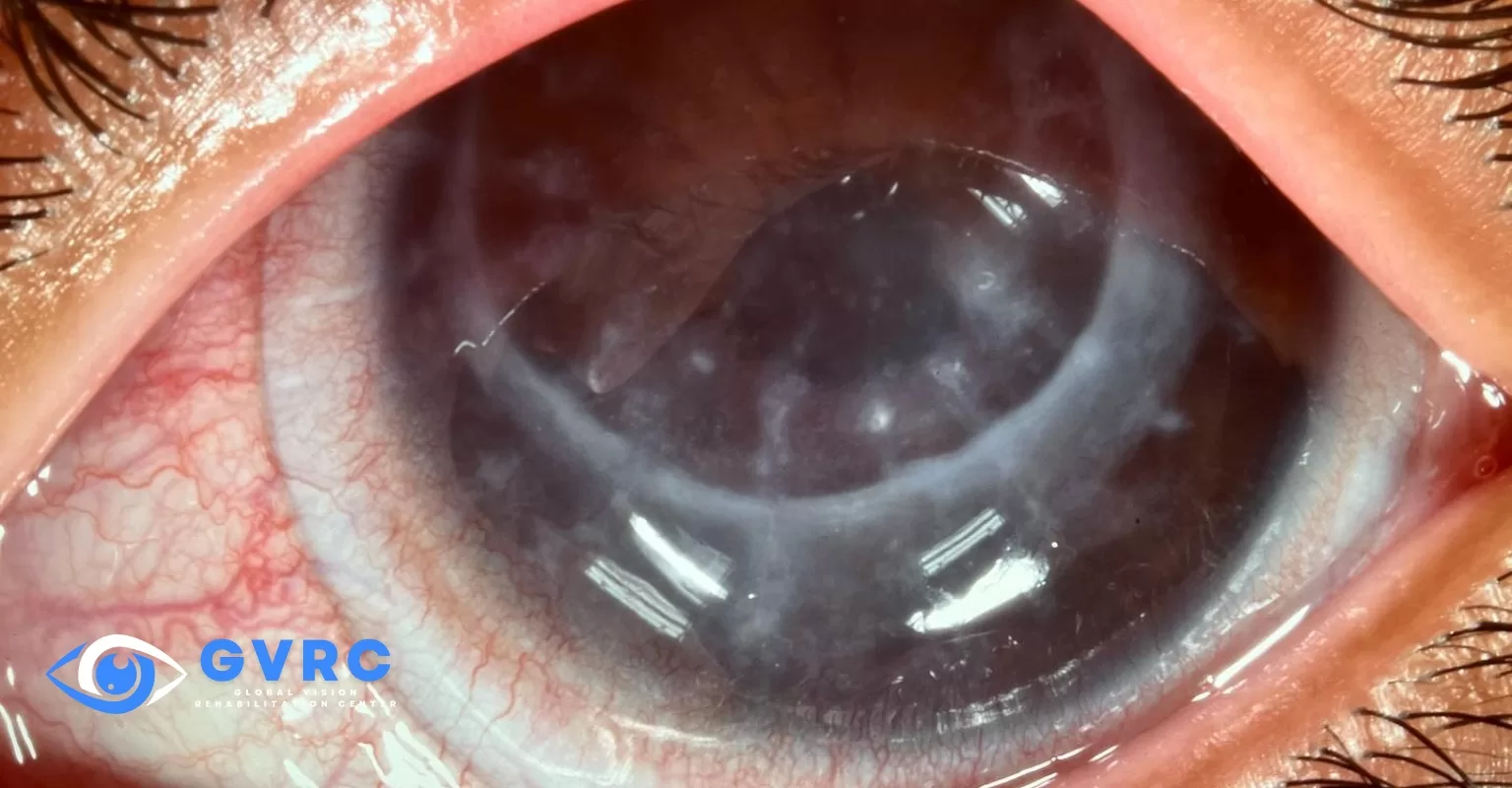 Fuchs Corneal Dystrophy & Scleral Lenses Treatment Guide