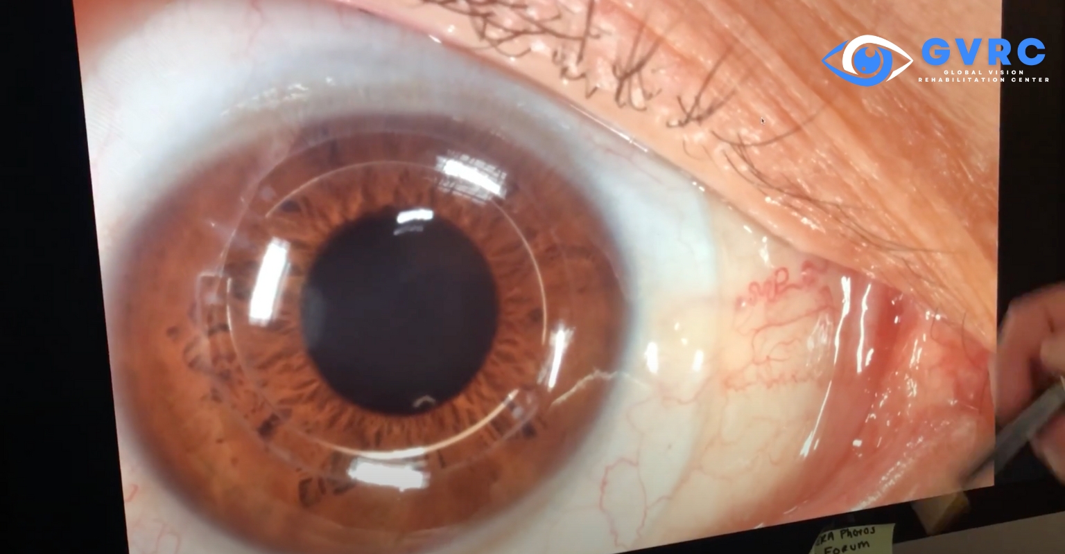 Eye Keratoconus & Scleral Lenses Dr. Boshnick's Solutions