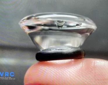 Scleral Lens Dry Eye Syndrome
