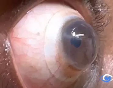 Close-up of a scleral lens on an eye during a specialty fitting