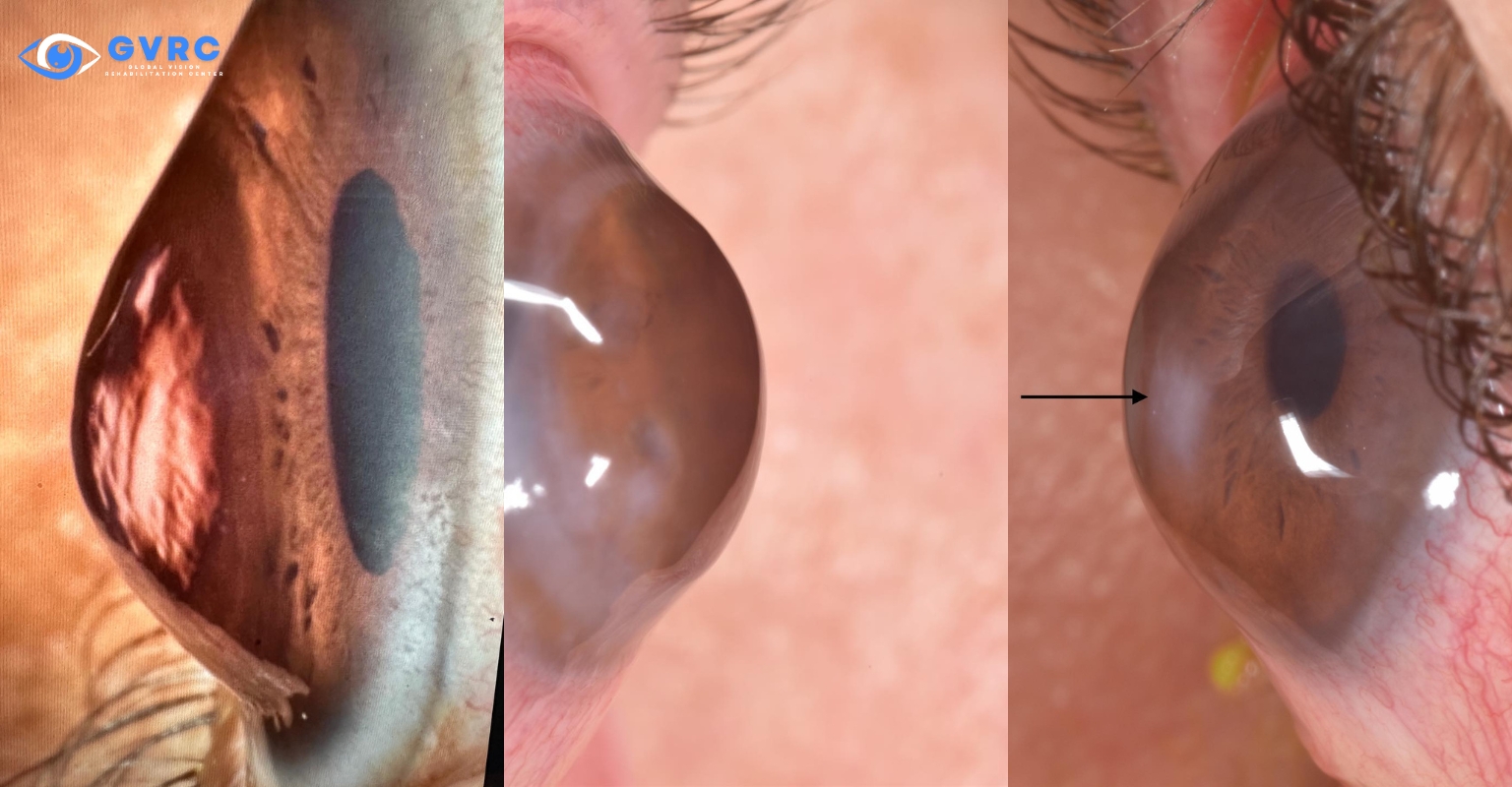 Person applying a scleral lens to manage keratoconus symptoms