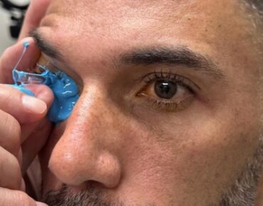 Doctor fitting a keratoconus patient with scleral lenses