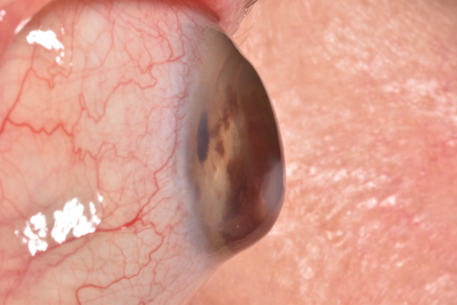 Ojo con queratocono evaluado para rehabilitación visual