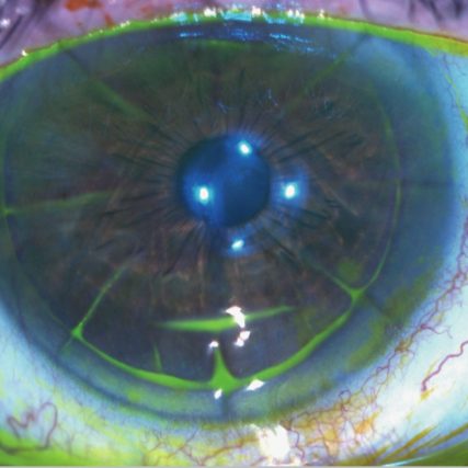 Post-LASIK corneal changes and specialty lens evaluation