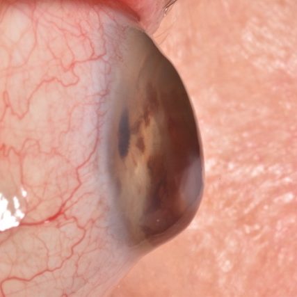 Post-LASIK corneal changes and specialty lens evaluation
