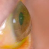 corneal-disease-eye-freedom-global-vision-rehabilitation-center-miami