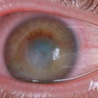 corneal-disease-rehabilitation-specialty-lenses-inflammation-and-ocular-surface-diseases-1