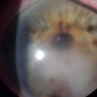 corneal-disease-rehabilitation-specialty-lenses-inflammation-and-ocular-surface-diseases-16