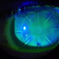 corneal-disease-rehabilitation-specialty-lenses-inflammation-and-ocular-surface-diseases-18