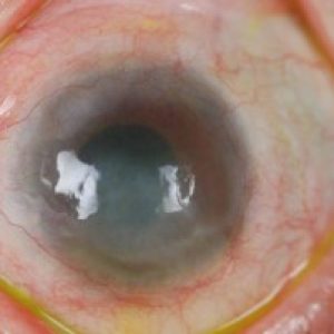 Corneal disease and specialty contact lens evaluation