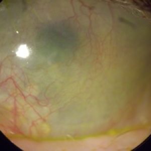 Corneal disease and specialty contact lens evaluation