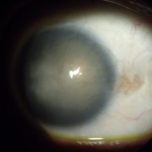 Corneal disease and specialty contact lens evaluation