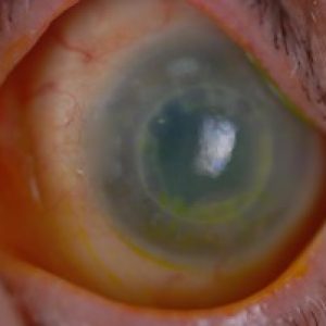Corneal disease and specialty contact lens evaluation