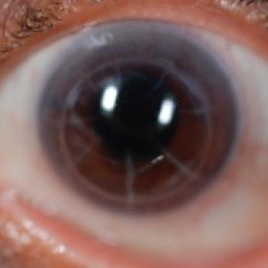 corneal-ectasia-treatments-3