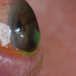 corneal-ectasia-treatments-4