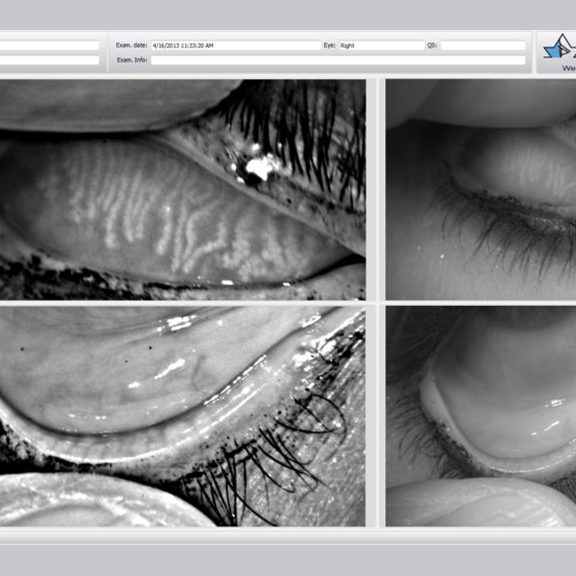 Dry eye syndrome and ocular surface disease illustration