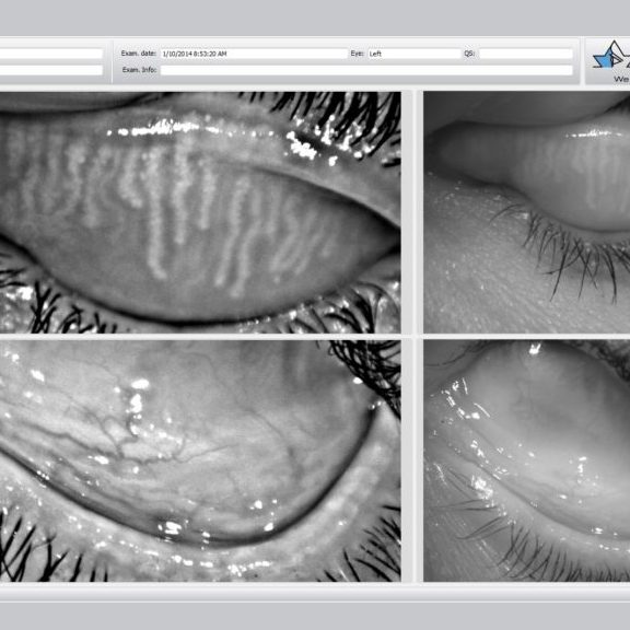 Dry eye syndrome and ocular surface disease illustration