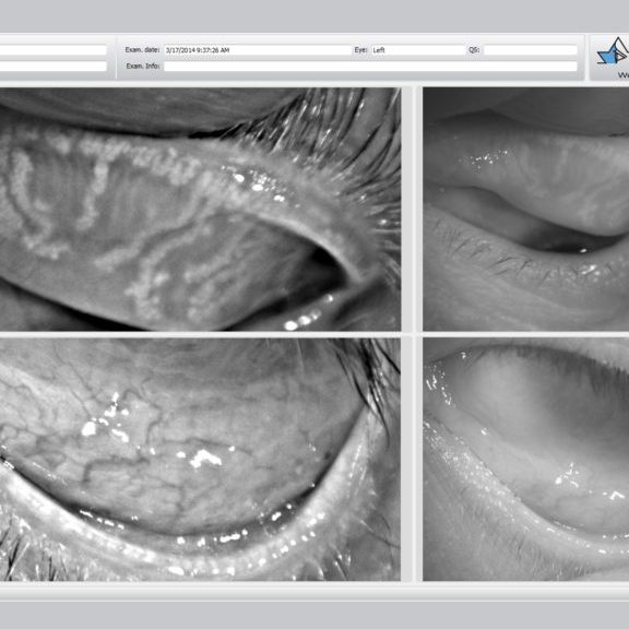 Dry eye syndrome and ocular surface disease illustration