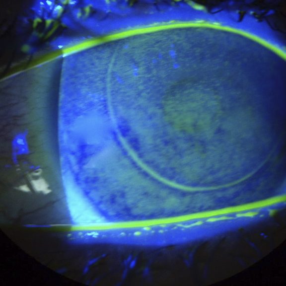 Dry eye syndrome and ocular surface disease illustration