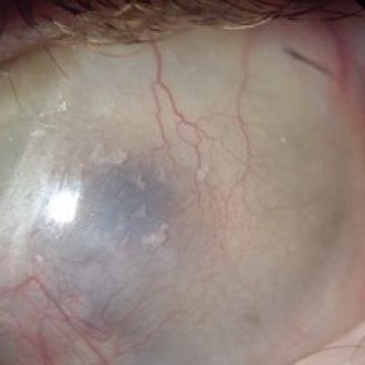 Custom scleral lenses for complex corneal and ocular surface conditions