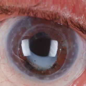 Custom scleral lenses for complex corneal and ocular surface conditions