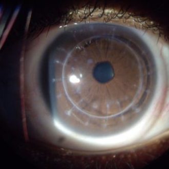Custom scleral lenses for complex corneal and ocular surface conditions
