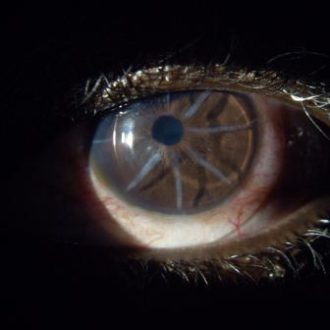 Custom scleral lenses for complex corneal and ocular surface conditions
