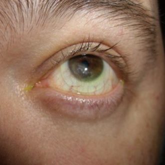 Custom scleral lenses for complex corneal and ocular surface conditions
